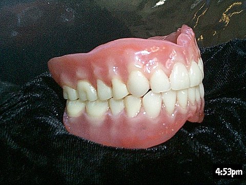 Custom stained full upper and lower denture